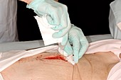Treating an open laparotomy wound