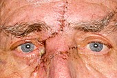 Face wound after removing skin cancer