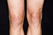 Swollen knee from a sport's injury