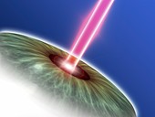 Laser eye surgery,computer artwork