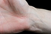 Carpel tunnel scar on the wrist