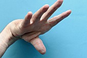 Poliomyelitis of the hand