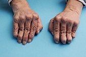 Hands with rheumatoid arthritis
