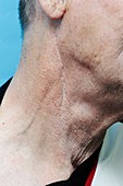 Carotid endarterectomy scar in neck