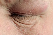 Supraorbital infection of the eye
