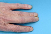 Syndactyly of the fingers