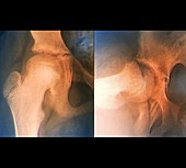 Slipped end of thigh bone,X-ray