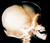 Bone growth disorder of skull,X-ray