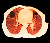 Lung abscess,CT scan