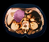 Cystic pancreas tumour,CT scan