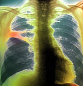 Collapse (atelectasis) of lung,X-ray