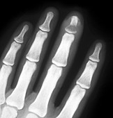 Inflamed bone of the finger,X-ray