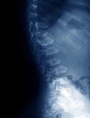 Spine in Morquio syndrome,X-ray