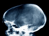 Dolichocephalic skull deformity,X-ray