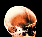 Skull in Apert-Crouzon syndrome,X-ray