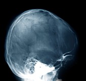 Normal flattening of the skull,X-ray