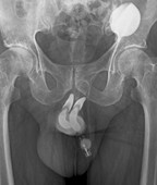 Penis prosthesis with pump,X-ray