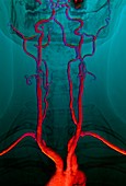 Neck arteries to the brain,3D MRI scan
