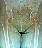 Atherosclerosis in femoral arteries X-ray