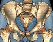 Healthy pelvis,3D CT scan