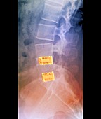 Fusion of spinal bones,X-ray