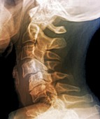Dislocated neck bones,X-ray
