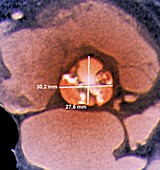 Calcified heart valve,CT scan