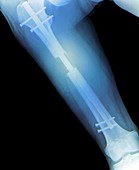 Extension of the thigh bone,X-ray