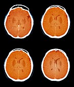 Brain in a coma,CT scan