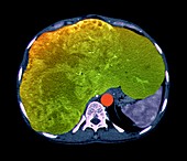 Liver cancer,CT scan