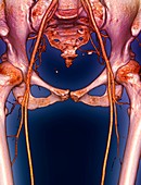 Pelvic arteries,3D CT scan