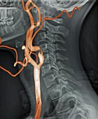 Stenosis of carotid artery,3D CT scan