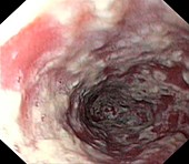 Thrush in the oesophagus