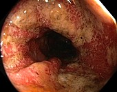 Ulcerative colitis in the sigmoid colon