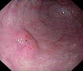 Early gastric cancer in the stomach