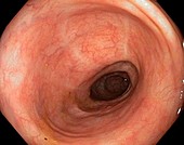 Scars in colon after ulcerative colitis