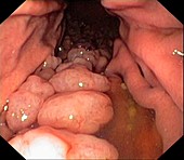 Hyperplastic polyps in the stomach