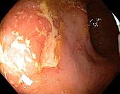 Crohn's disease in the rectum