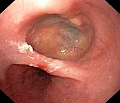 Diverticulum in the oesophagus