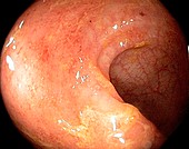 Ulcerative proctitis in the rectum