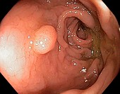 Benign adenoma in the rectum