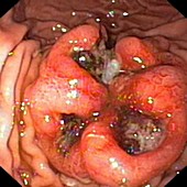 Metastatic cancer in the stomach