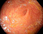 Appendix aperture in the caecum