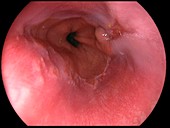 Oesophagitis grade A from reflux
