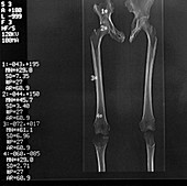 Ancient Greek athlete's skeleton,X-ray