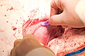 Carotid endarterectomy surgery
