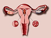 Contraceptive coil in uterus,artwork