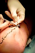 Varicose vein removal