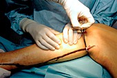 Varicose vein removal