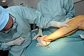 Varicose vein removal